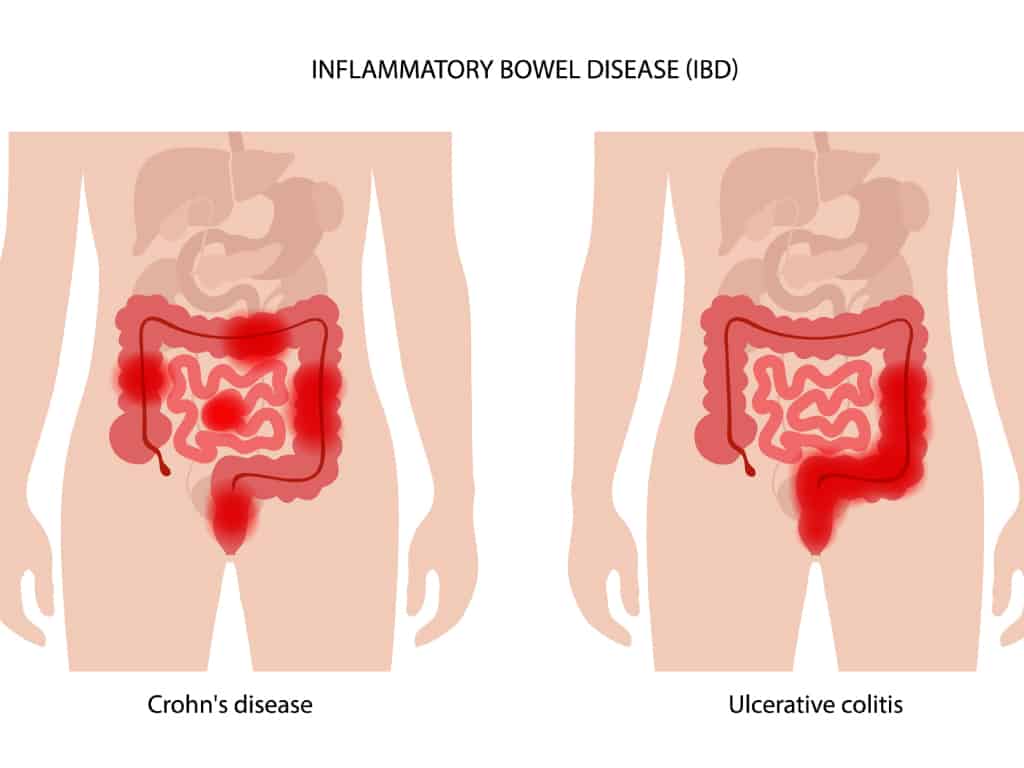 Crohn's disease vs Ulcerative colitis