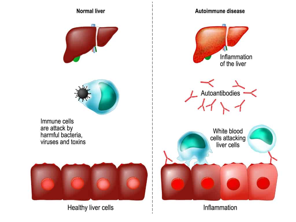 Healthy-liver-VS-Autoimmune-Disease