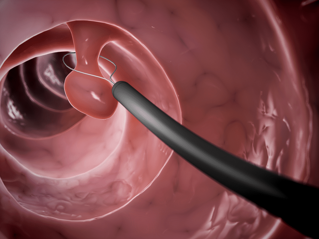 How are Colorectal Polyps treated?