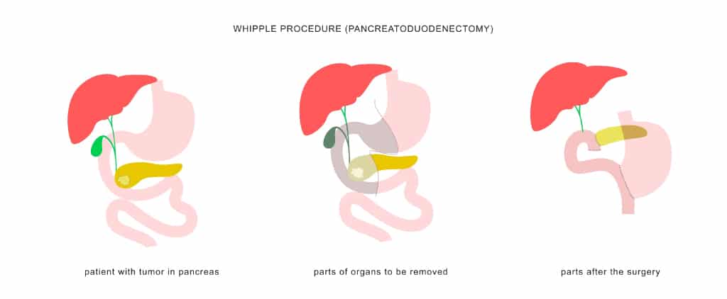 Illsutration of Whipple Procedure