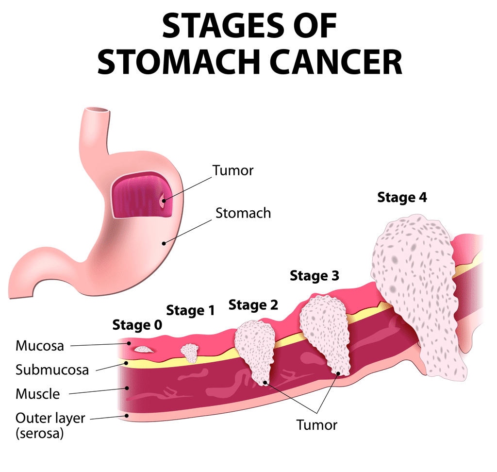 Illustration of the stages of stomach cancer