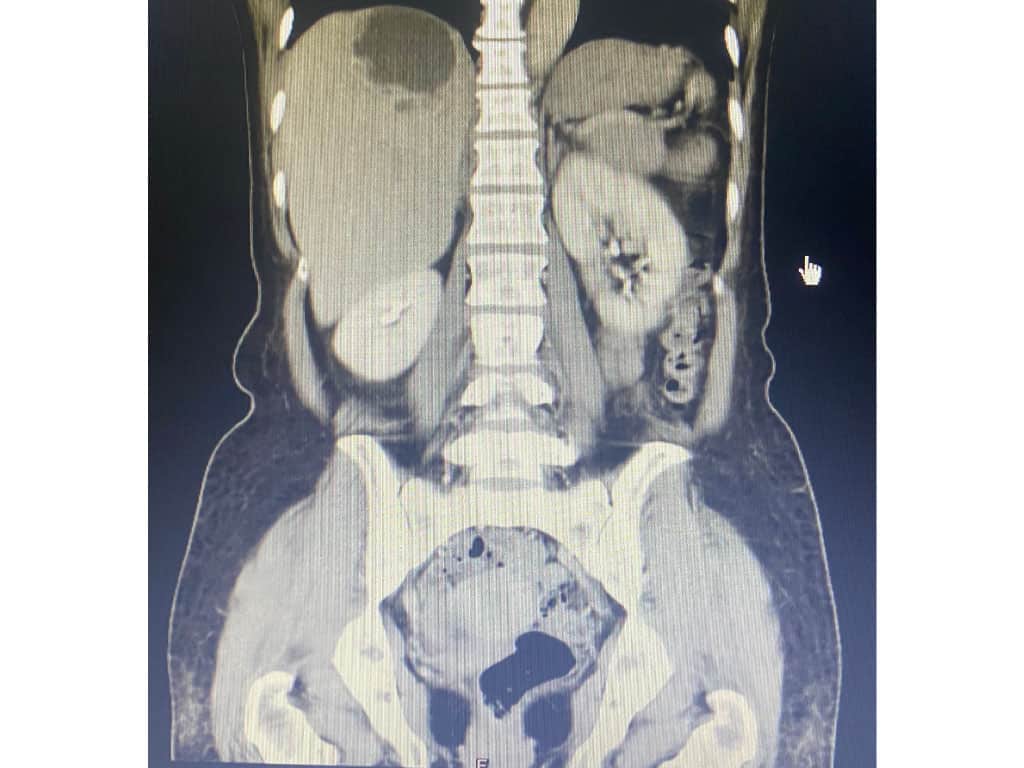 Xray of liver cysts