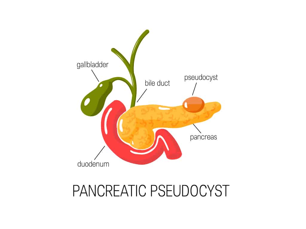 Pancreatic Cysts