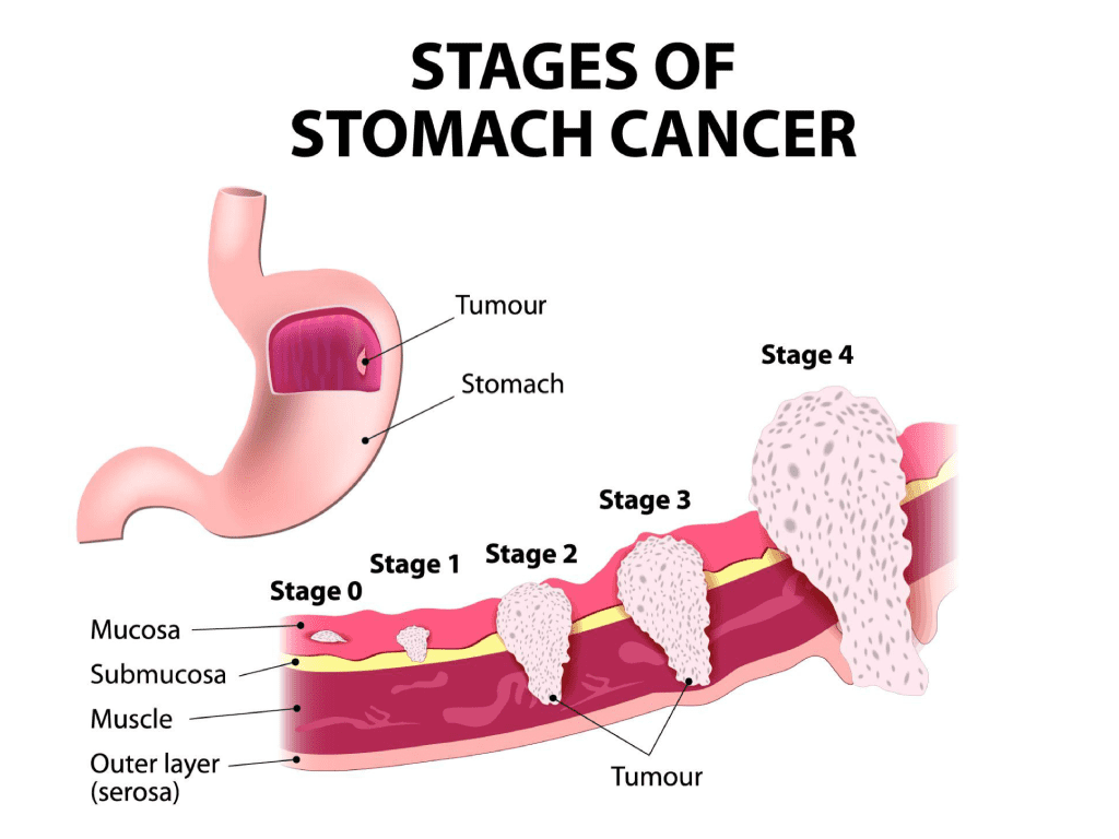 Stages of stomach cancer