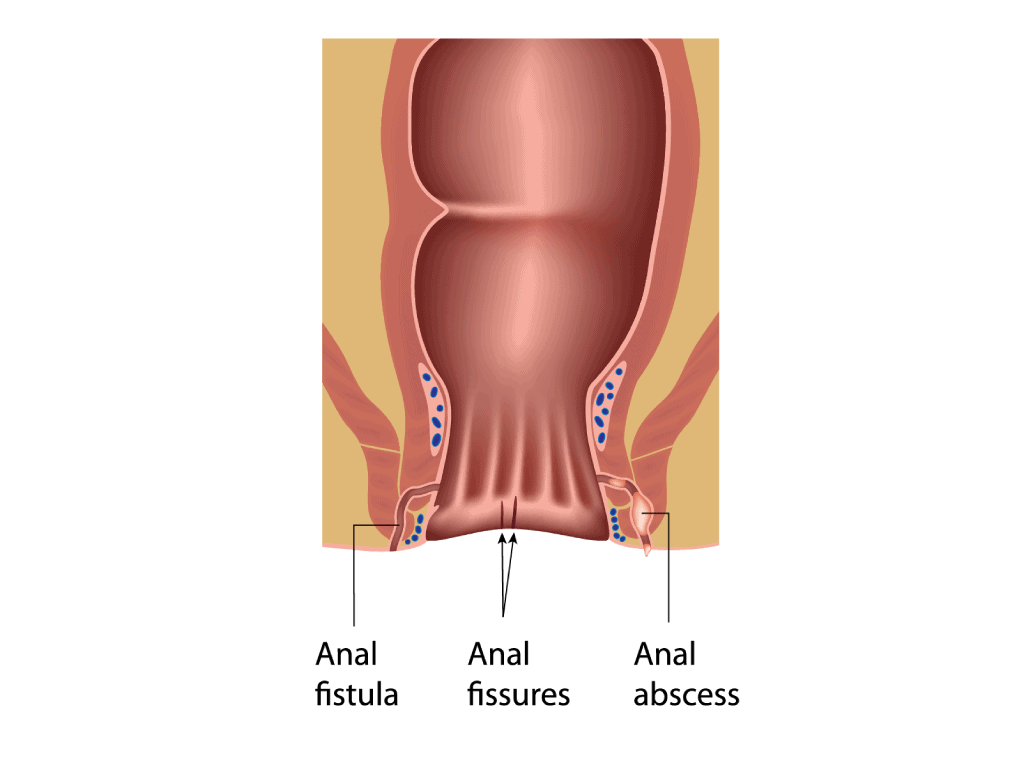 What does an Anal Fissure look like?