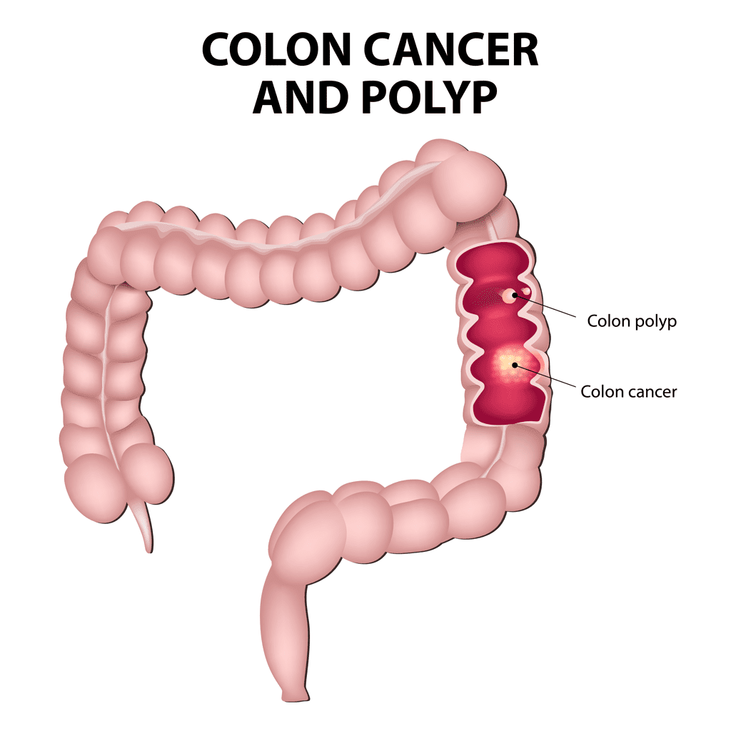 Illustration of Colon Cancer