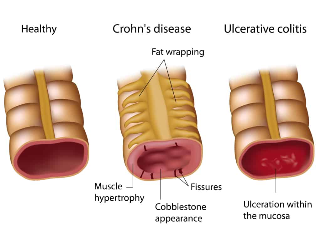 healthy-vs-Crohn's-disease-vs-Ulcerative-colitis