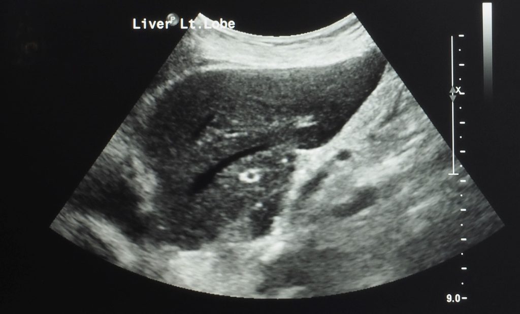 Ultrasound pic of liver