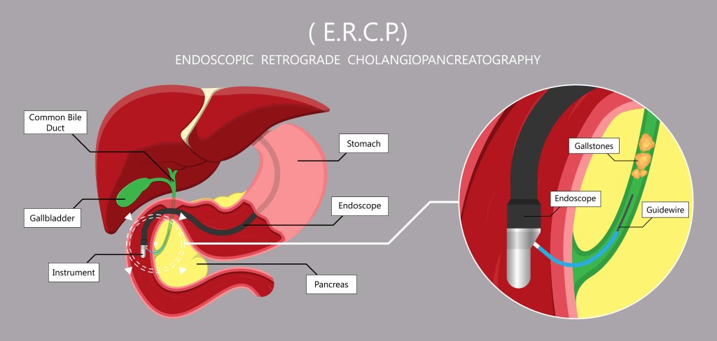  ERCP procedure