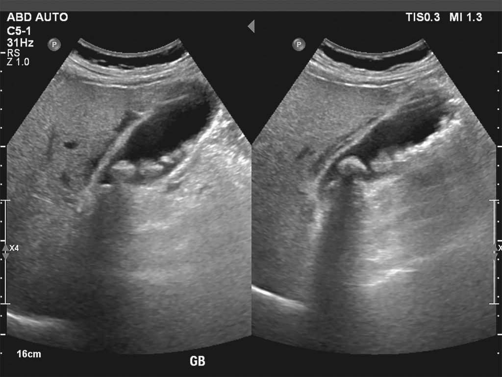 Ultrasound image of Gallbladder stones