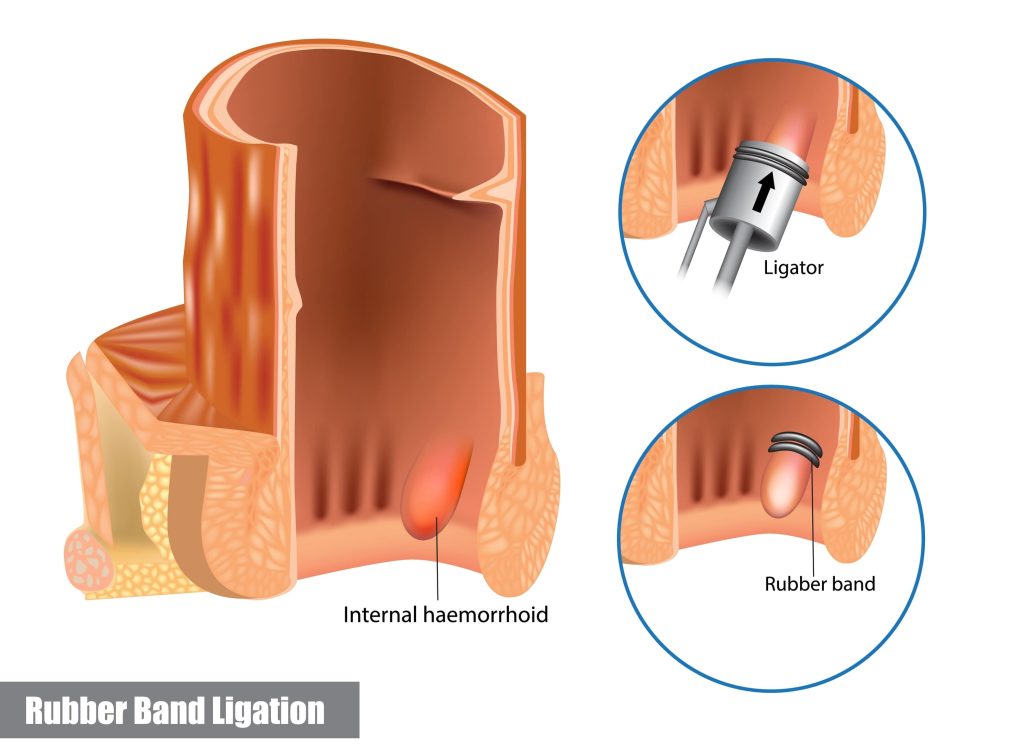 illustration of Rubber band ligation