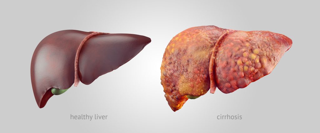 Healthy Liver vs Cirrohosis