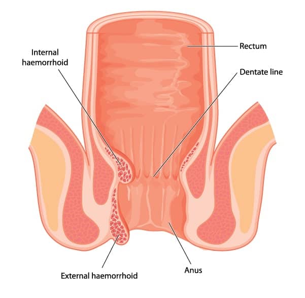 what are haemorrhoids?