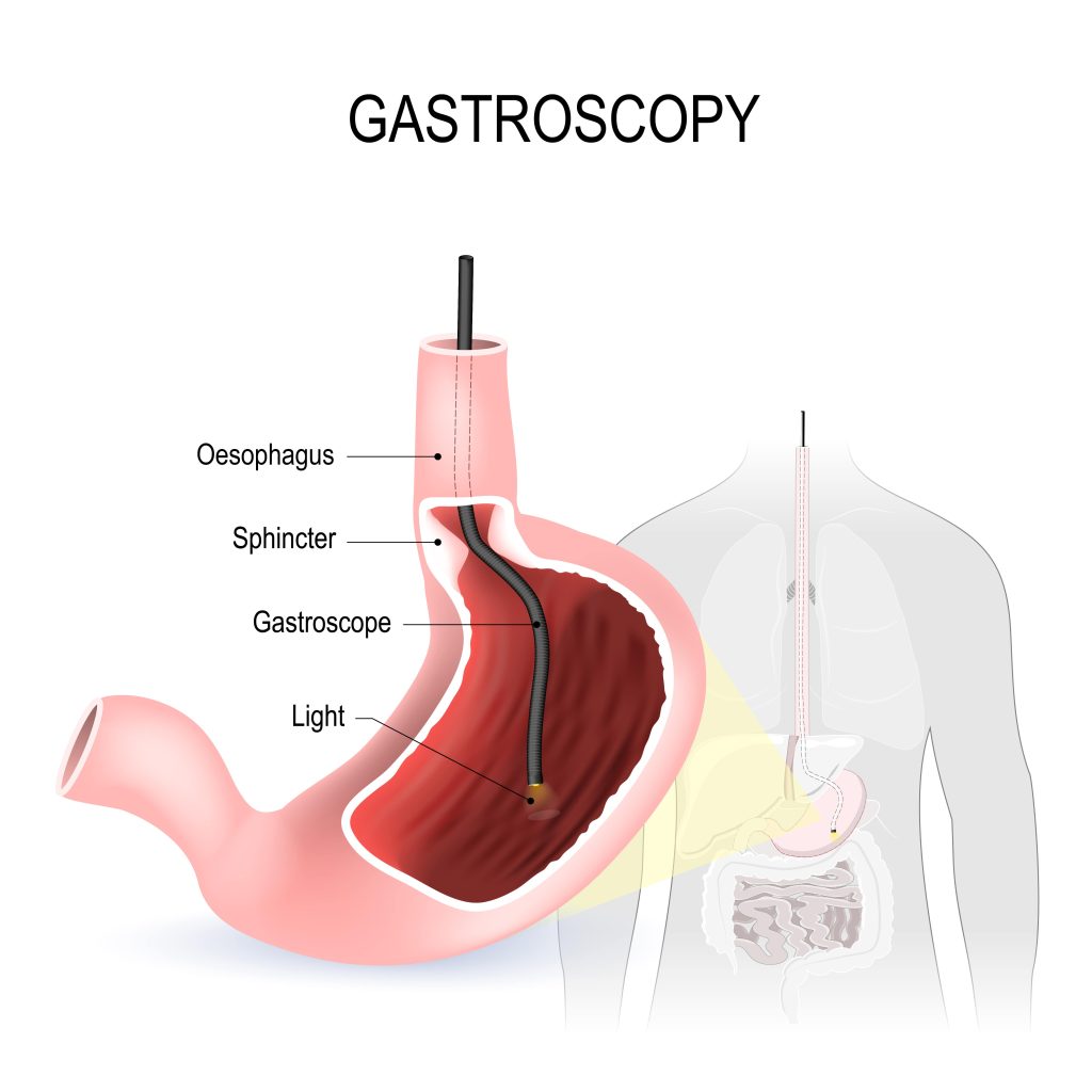 Illustration of Gastroscopy