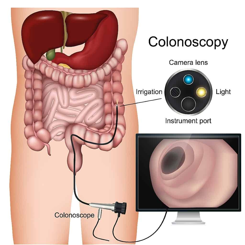 Illustration of Colonoscopy