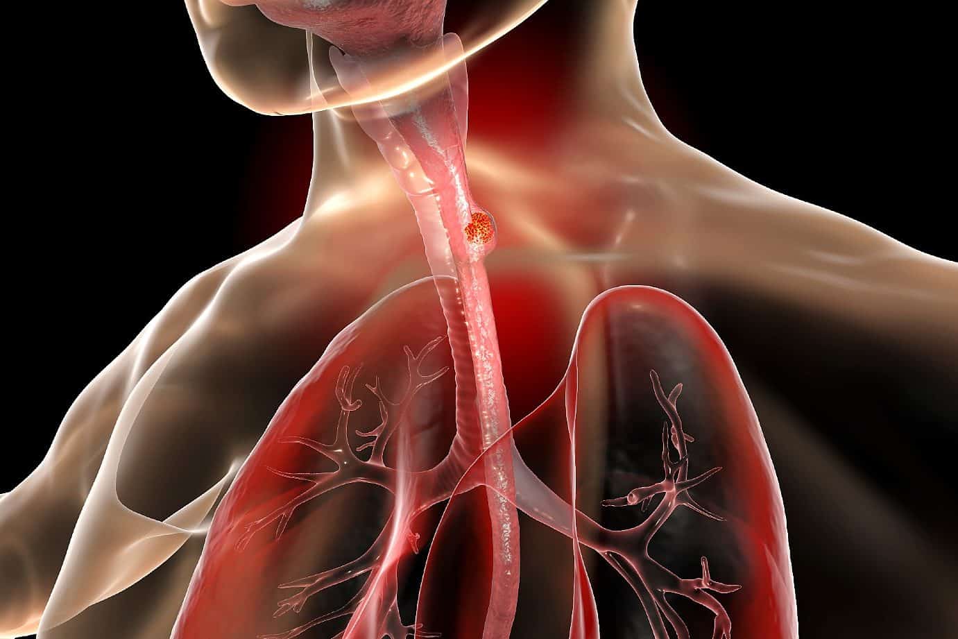 Oesophageal Cancer In Singapore Alpha Digestive Liver Centre