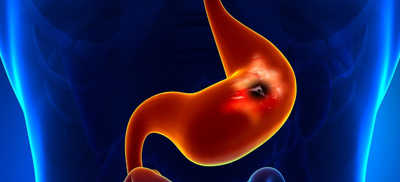 Peptic Ulcer Disease In Singapore Alpha Digestive And Liver Centre 