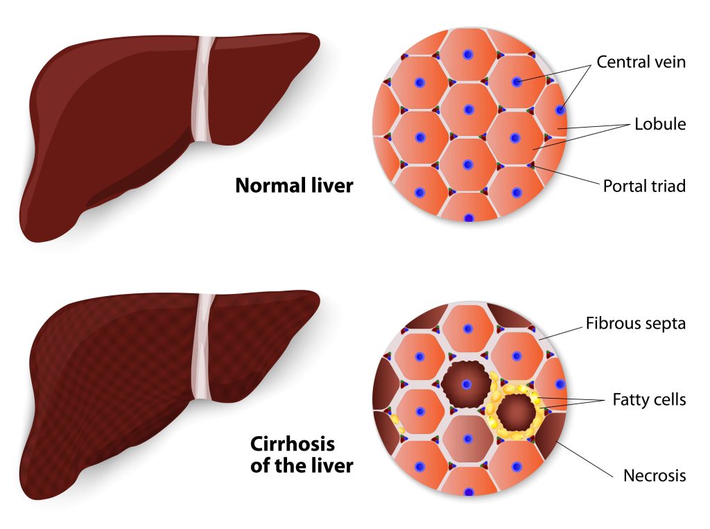 Normal liver vs Cirrhosis of the liver