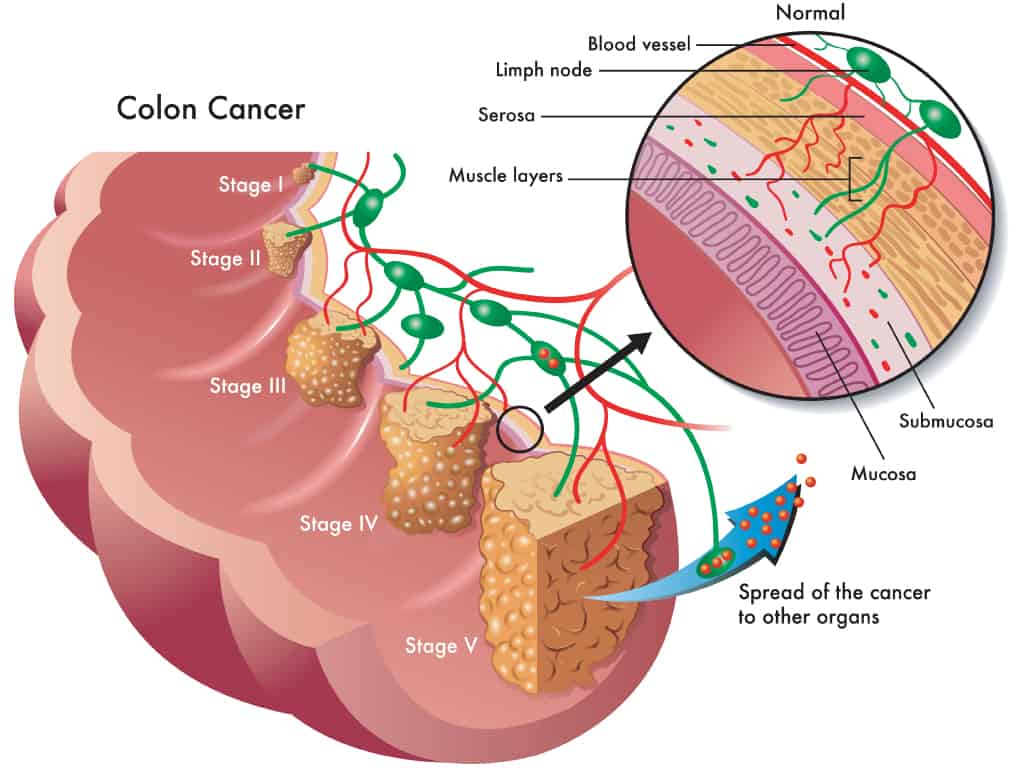 Illustration-of-colon-cancer