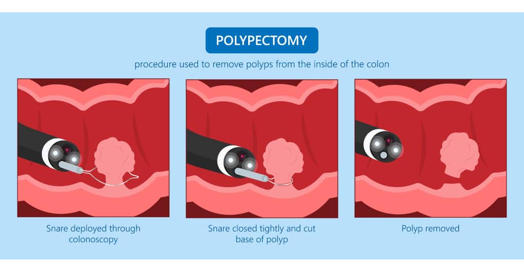 Step-by-step-illustration-of-polyp
