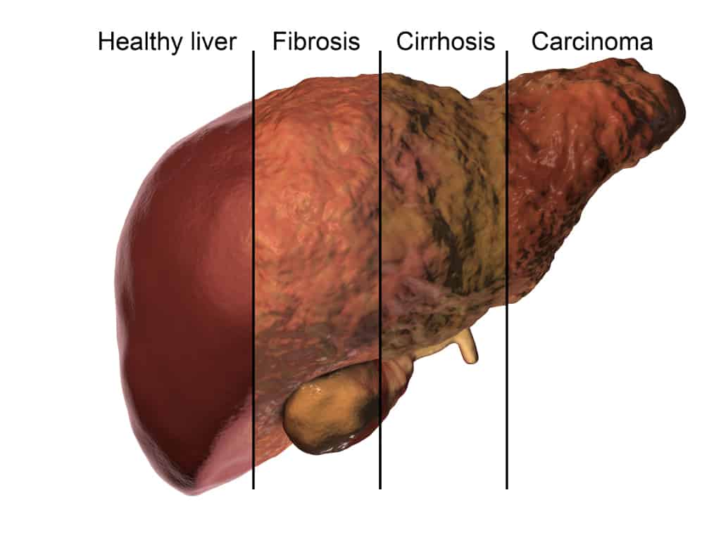 Healthy liver VS unhealthy liver