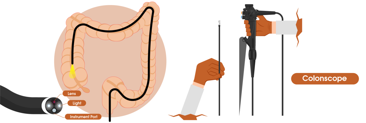 Endoscopic view of anal fissure area for diagnosis