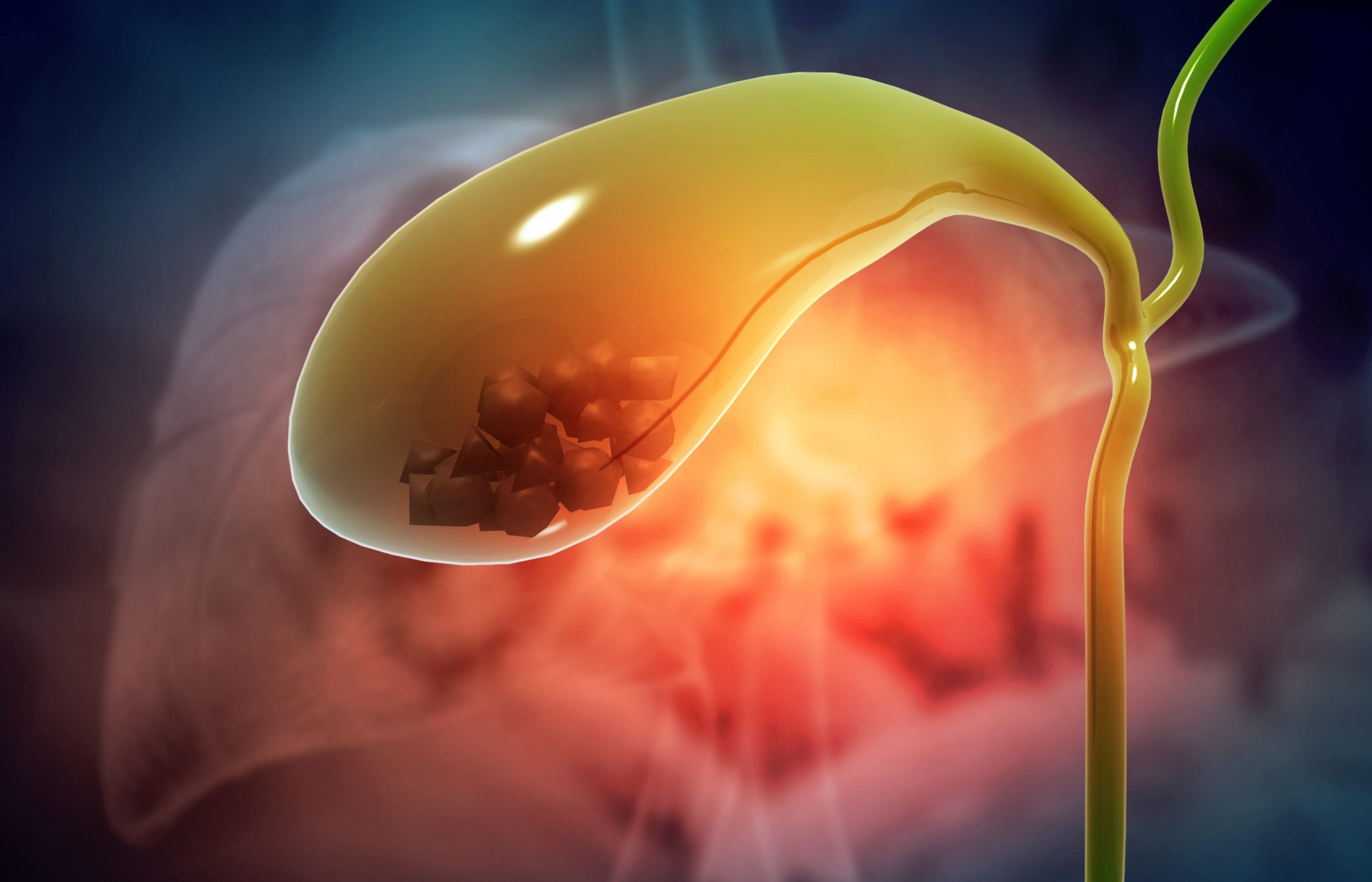 Gallbladder Stones in Singapore | Alpha Digestive & Liver Centre