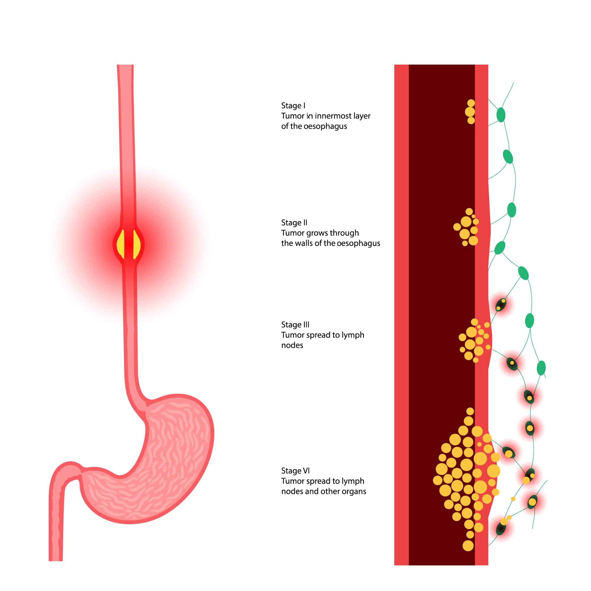 Stages of Oesophageal Cancer