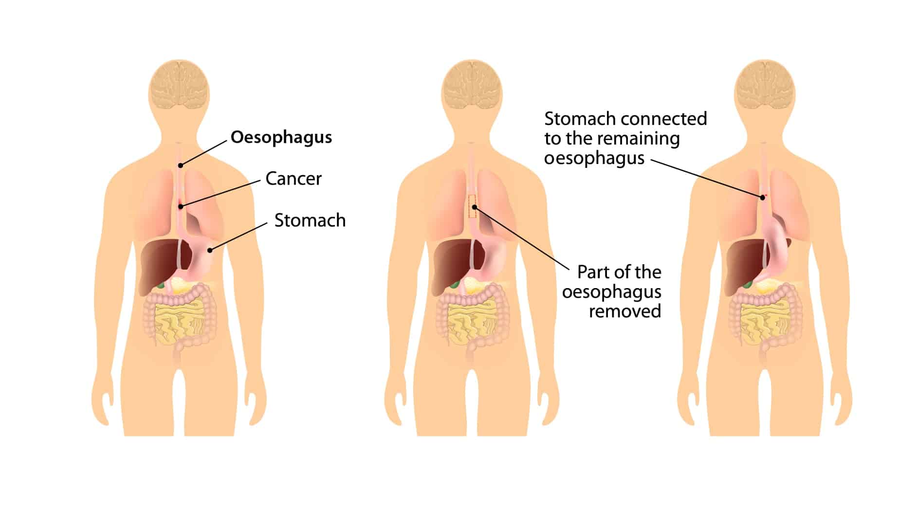 How is Oesophageal Cancer treated?