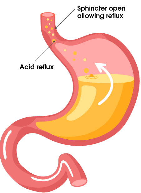 acid reflux singapore