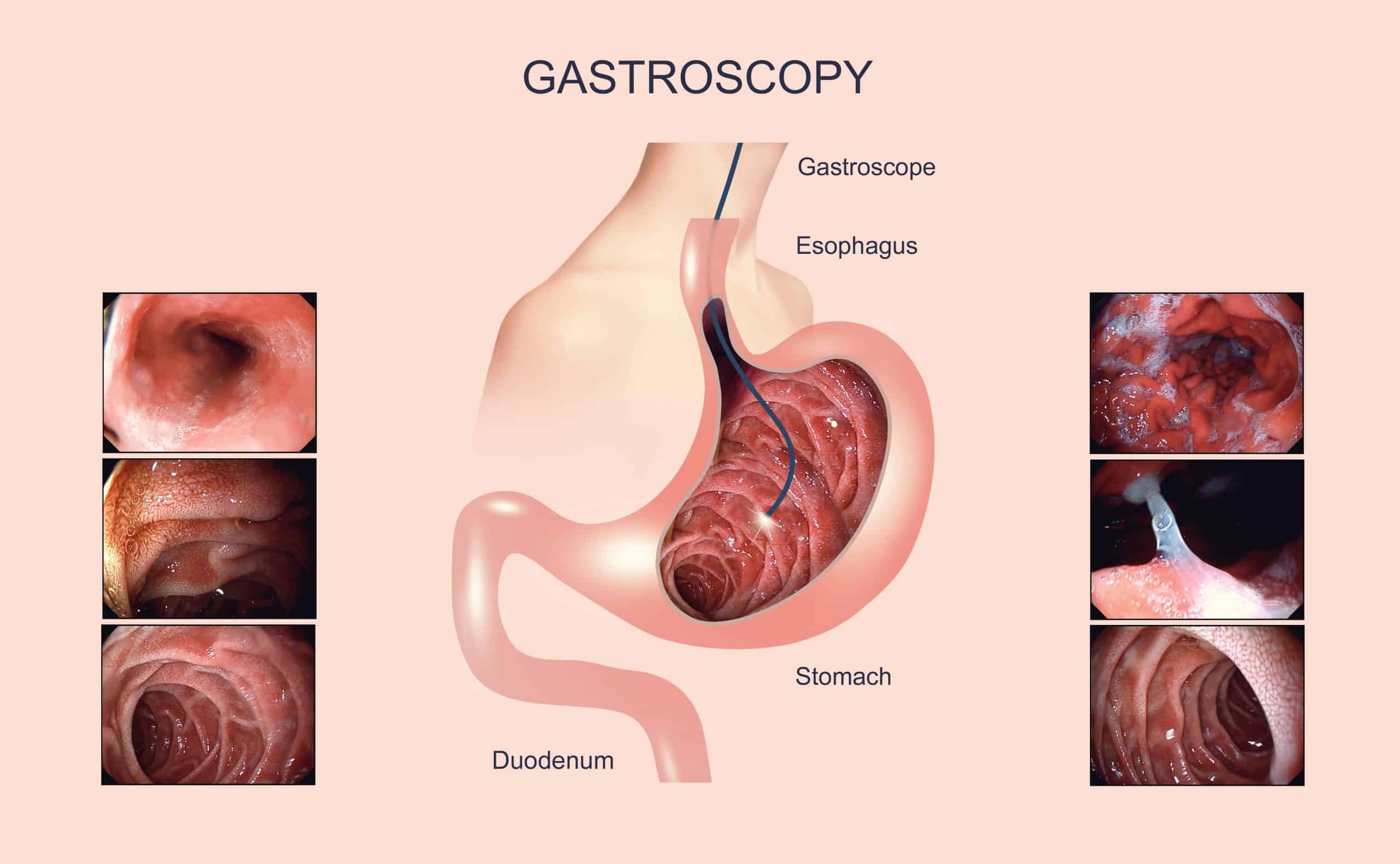 gastroscopy